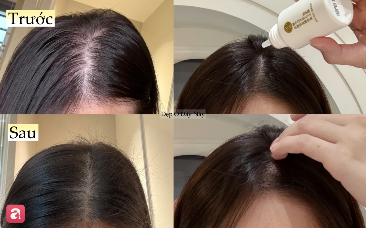 T&oacute;c rụng đến nỗi lộ cả mảng da đầu, t&ocirc;i quyết định theo 5 quy tắc chăm s&oacute;c sau để t&oacute;c đen d&agrave;y trở lại- Ảnh 5.