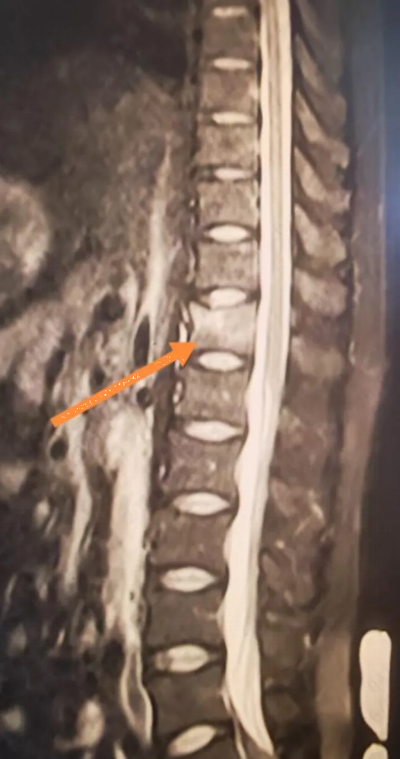 Người đ&agrave;n &ocirc;ng 34 tuổi xương gi&ograve;n như b&agrave; cụ 60 tuổi v&igrave; ng&agrave;y n&agrave;o cũng uống 3 cốc loại nước nhiều người kh&ocirc;ng thể sống thiếu - Ảnh 1.