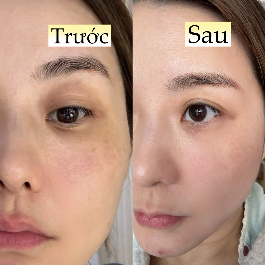 Đi ngủ sớm v&agrave; b&ocirc;i thứ n&agrave;y l&ecirc;n da mỗi tối, l&agrave;n da của t&ocirc;i sau 1 th&aacute;ng đ&atilde; thay đổi ho&agrave;n to&agrave;n- Ảnh 6.