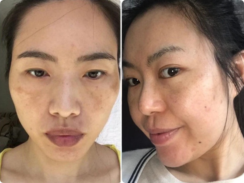 Chi&ecirc;u nhỏ khi b&ocirc;i kem chống nắng gi&uacute;p ngăn n&aacute;m v&agrave; t&agrave;n nhang, kh&ocirc;ng phải ai cũng n&oacute;i cho bạn biết- Ảnh 1.