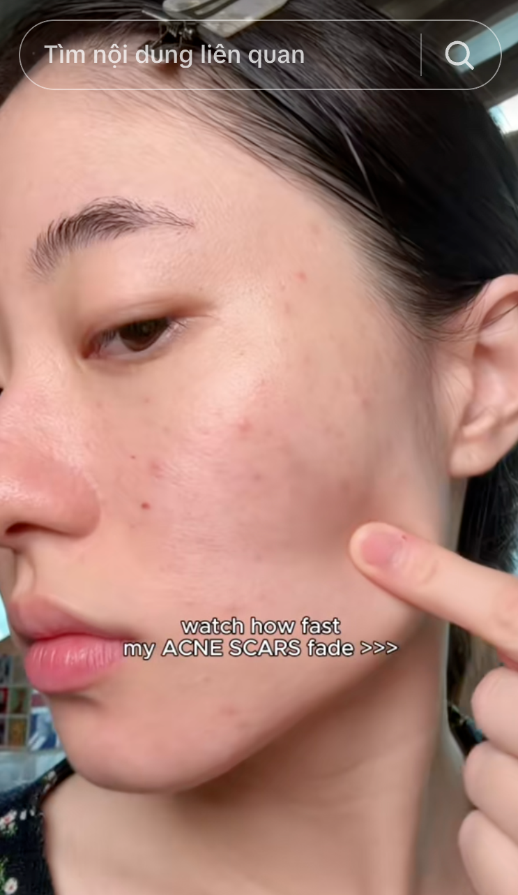 Da mặt th&acirc;m mụn, v&ugrave;ng n&aacute;ch sạm đen hay khuỷu tay th&ocirc; r&aacute;p: Phụ nữ H&agrave;n giải quyết tất cả bằng một tu&yacute;p Vitamin C - Ảnh 1.