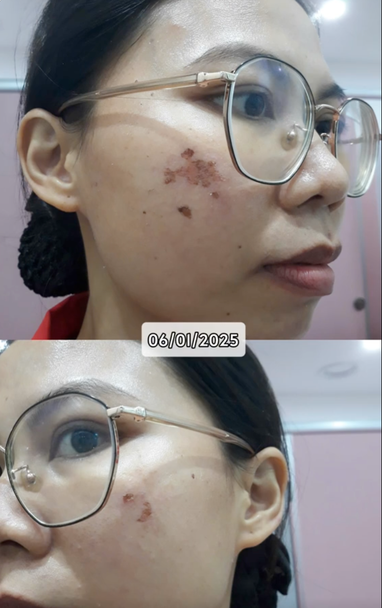 H&agrave;nh tr&igrave;nh dưỡng kh&iacute; huyết "cứu" da hư tổn của c&ocirc; n&agrave;ng tuổi 30: Từng &ldquo;toang&rdquo; v&igrave; peel da, giờ da dẻ hồng h&agrave;o, căng mịn, khỏe từ b&ecirc;n trong- Ảnh 2.