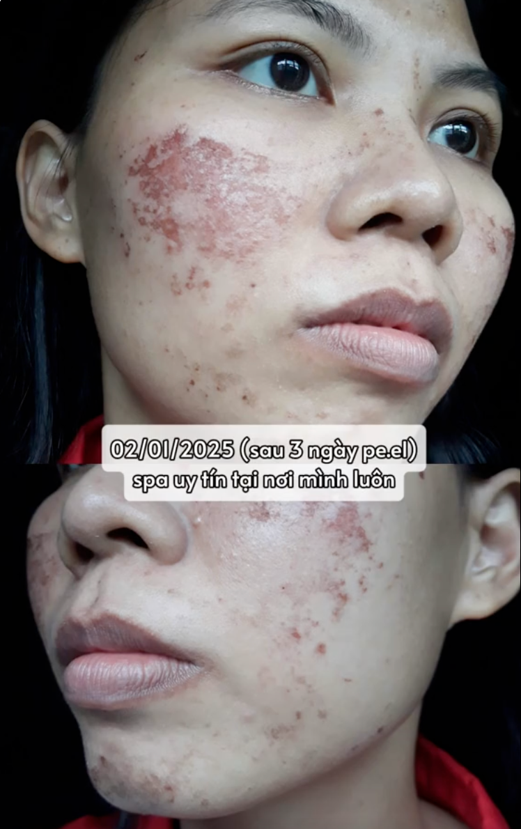 H&agrave;nh tr&igrave;nh dưỡng kh&iacute; huyết "cứu" da hư tổn của c&ocirc; n&agrave;ng tuổi 30: Từng &ldquo;toang&rdquo; v&igrave; peel da, giờ da dẻ hồng h&agrave;o, căng mịn, khỏe từ b&ecirc;n trong- Ảnh 1.