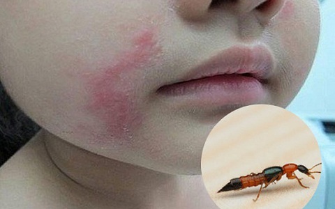 B&aacute;c sĩ BV Bạch Mai cảnh b&aacute;o căn bệnh vi&ecirc;m da do một loại c&ocirc;n tr&ugrave;ng g&acirc;y ra: Cực độc, rất dễ nhầm lẫn với bệnh Zona v&agrave; gặp nhiều v&agrave;o m&ugrave;a h&egrave; - Ảnh 3.