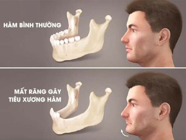 Đi khám răng định kỳ, thiếu nữ 17 tuổi tình cờ phát hiện u nang trong xương hàm và căn bệnh di truyền nguy hiểm suýt bị bỏ quên! - Ảnh 1.