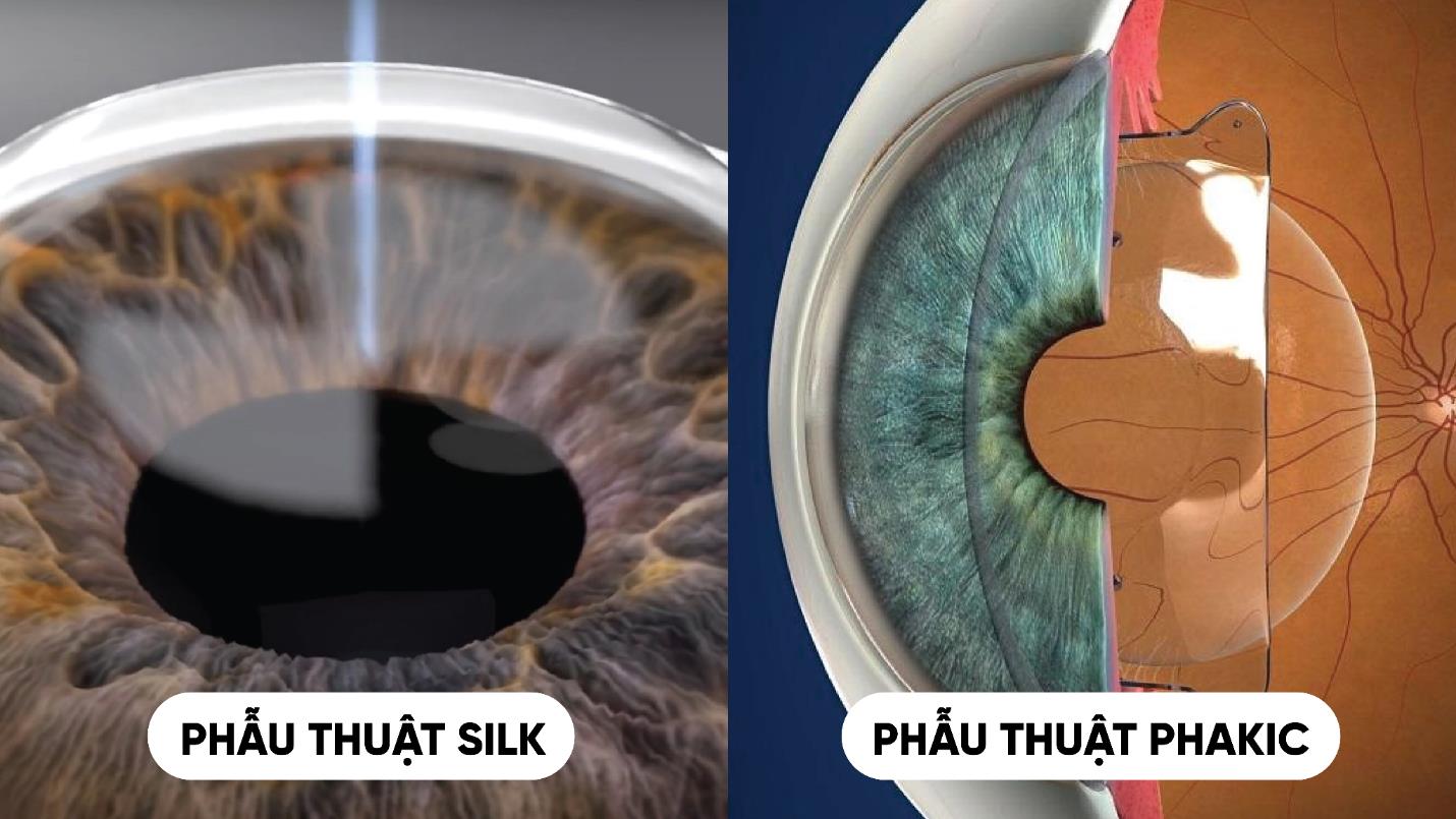 X&oacute;a cận m&ugrave;a h&egrave;: Đ&acirc;u l&agrave; lựa chọn ph&ugrave; hợp cho người trẻ năng động?- Ảnh 2.