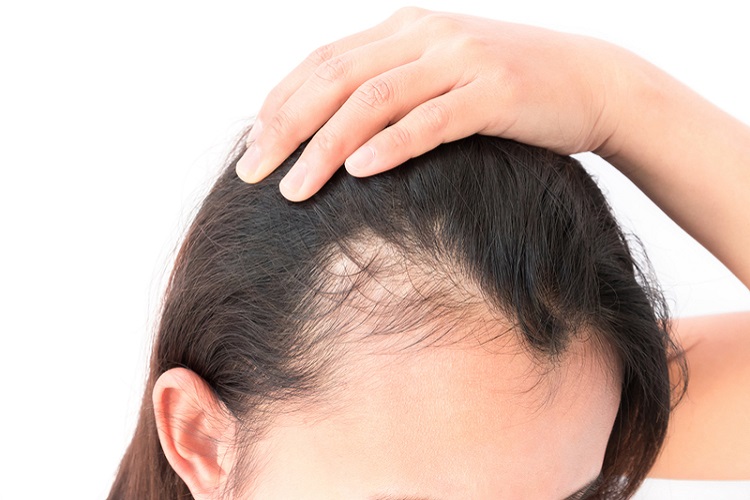 Gội đầu kiểu này cực hại da đầu lại dễ gây hói: Đáng tiếc nhiều người Việt vẫn mắc, thay đổi ngay hôm nay để cứu lấy mái tóc- Ảnh 2. Gội đầu kiểu này cực hại da đầu lại dễ gây hói: Đáng tiếc nhiều người Việt vẫn mắc, thay đổi ngay hôm nay để cứu lấy mái tóc- Ảnh 2.