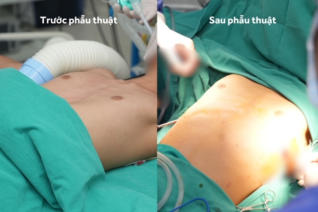 Vinmec Hải Phòng “hồi sinh” lồng ngực bị lõm cho cậu bé 13 tuổi bằng ca phẫu thuật tạo hình phức tạp - Ảnh 3.