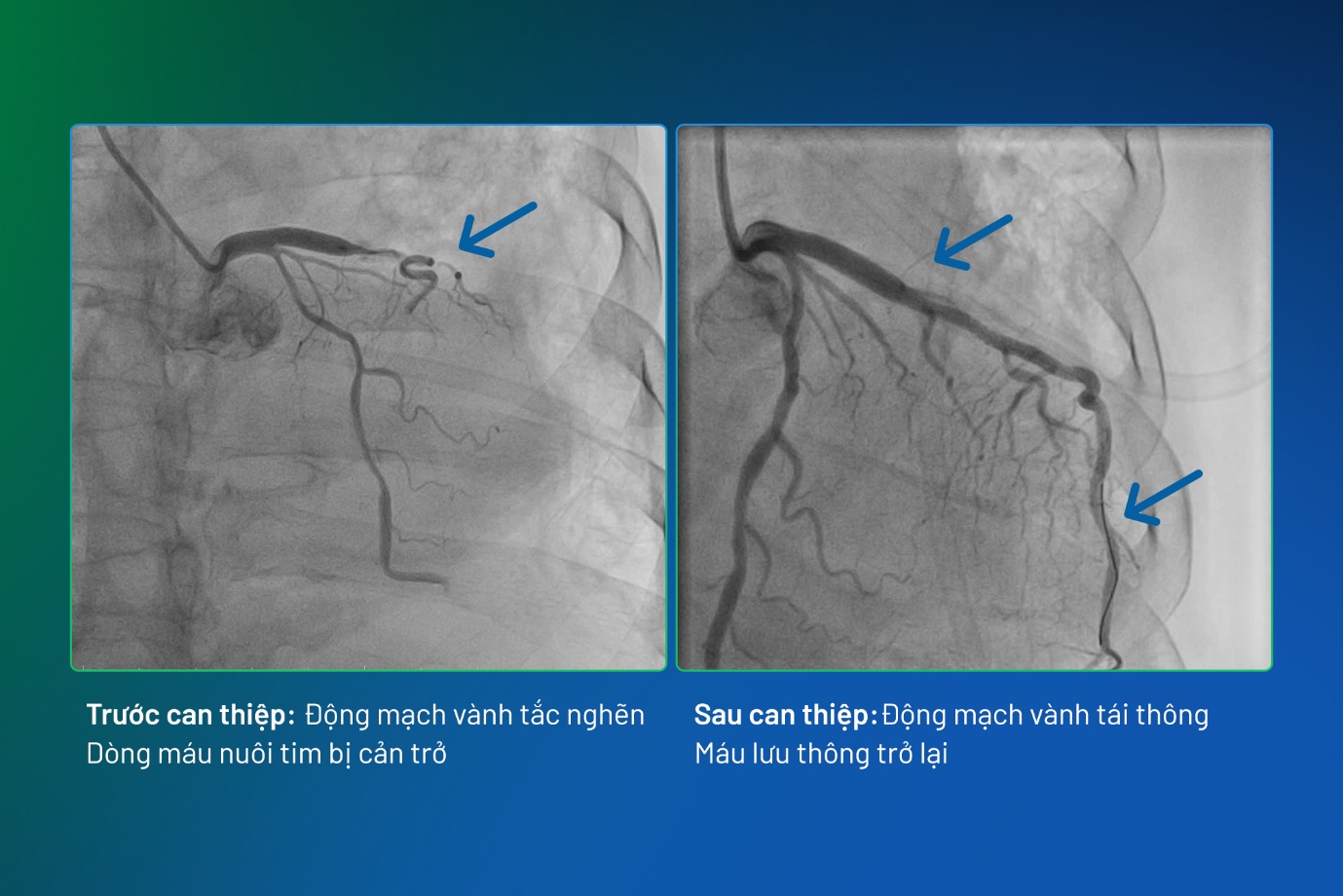 BVĐK Phương Đ&ocirc;ng cứu sống bệnh nh&acirc;n nhồi m&aacute;u cơ tim cấp giữa &ldquo;ma trận&rdquo; bệnh l&yacute; phức tạp - Ảnh 1.