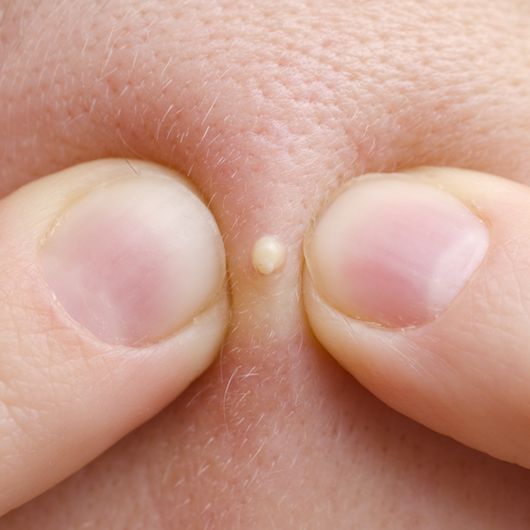 Vì sao nặn mụn hay ngoáy tai lại mang lại cảm giác sướng kỳ lạ đến thế? - Ảnh 1.