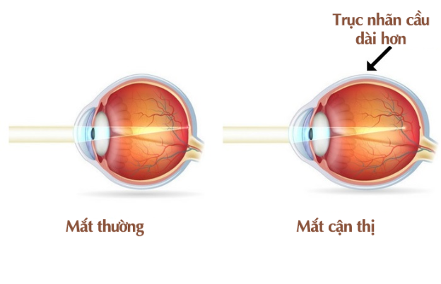 Độ cận tăng không chỉ khiến trẻ thay kính nhiều hơn: Những nguy cơ từ cận thị mà cha mẹ chưa biết - Ảnh 1.