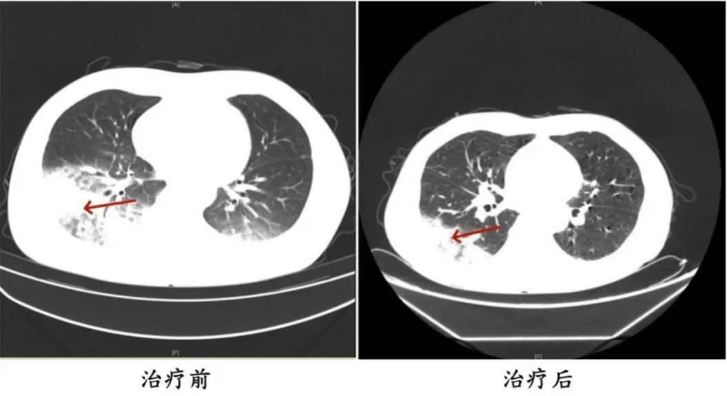 Bật điều hòa ngủ, người phụ nữ sốt cao liên tục, phổi tổn thương hơn một nửa: Bác sĩ cảnh báo mối nguy ít ai ngờ ngay trong nhà- Ảnh 2.