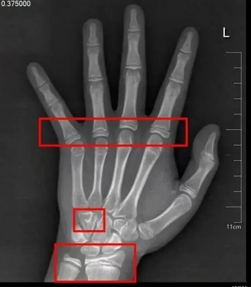 B&eacute; g&aacute;i 9 tuổi nhưng tuổi xương đ&atilde; đạt tới 12 tuổi, b&aacute;c sĩ cảnh b&aacute;o th&oacute;i quen g&acirc;y dậy th&igrave; sớm cho trẻ ở nhiều gia đ&igrave;nh - Ảnh 1.
