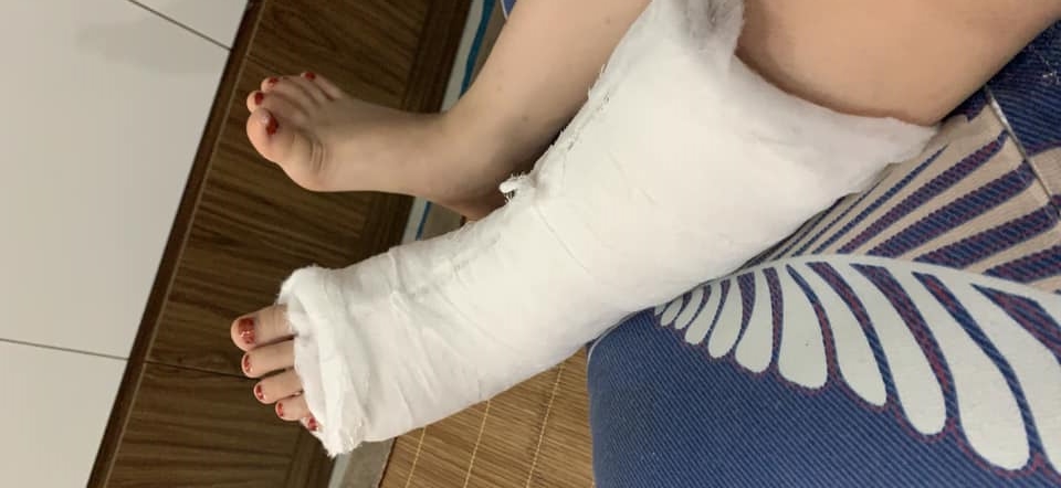 Hậu quả l&agrave;m ch&acirc;n tr&aacute;i bị chấn thương, phải b&oacute; bột