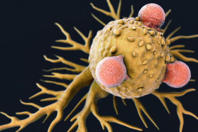 Thí nghiệm cho thấy virus COVID có thể thu nhỏ khối u của 4 loại ung thư giai đoạn cuối- Ảnh 1. Thí nghiệm cho thấy virus COVID có thể thu nhỏ khối u của 4 loại ung thư giai đoạn cuối- Ảnh 1.