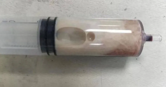 Thanh niên nhập viện sau bữa lẩu nướng, bác sĩ rút ra thứ chất lỏng khiến ai cũng rùng mình- Ảnh 1. Thanh niên nhập viện sau bữa lẩu nướng, bác sĩ rút ra thứ chất lỏng khiến ai cũng rùng mình- Ảnh 1.