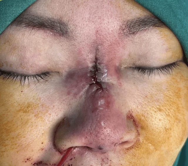 Người phụ nữ bị “ăn thủng mũi” sau khi làm đẹp đổi vận- Ảnh 1.