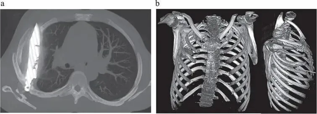 Người đ&agrave;n &ocirc;ng mang "thứ n&agrave;y" trong lồng ngực suốt 8 năm m&agrave; kh&ocirc;ng hề hay biết- Ảnh 2.