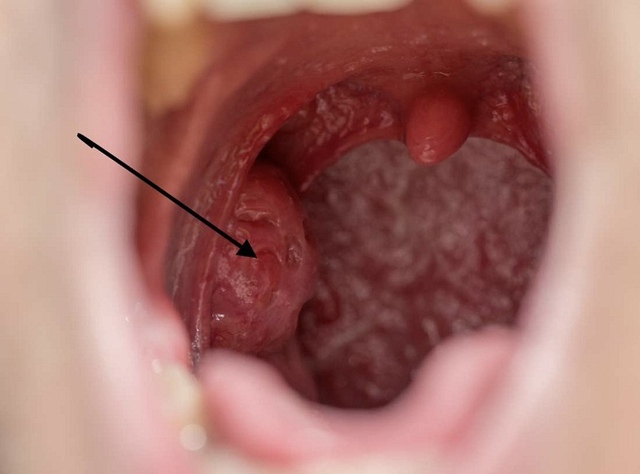 SỐC: 90% người bỏ qua dấu hiệu này và chỉ phát hiện khi ung thư đã vào giai đoạn muộn- Ảnh 1.