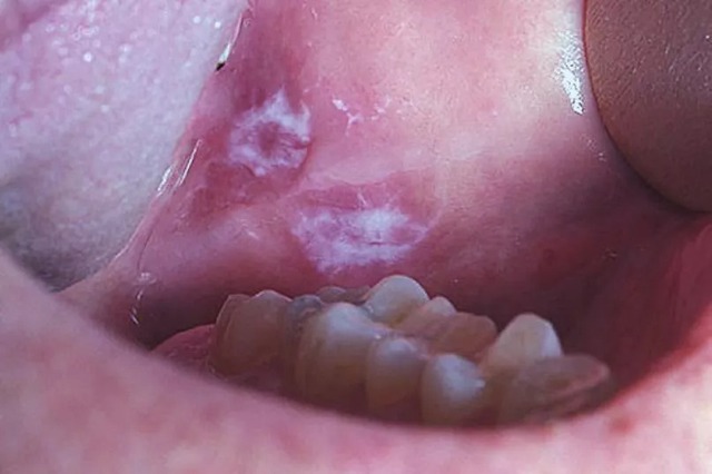 Nhiệt miệng mà có 3 đặc điểm này e rằng "che giấu" tế bào ung thư, khám ngay còn kịp!- Ảnh 2. Nhiệt miệng mà có 3 đặc điểm này e rằng "che giấu" tế bào ung thư, khám ngay còn kịp!- Ảnh 2.