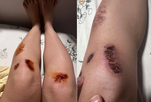 Dân văn phòng "nghiện" pickleball, “đau nhưng ham”, bác sĩ nhắc 1 việc- Ảnh 2. Dân văn phòng "nghiện" pickleball, “đau nhưng ham”, bác sĩ nhắc 1 việc- Ảnh 2.