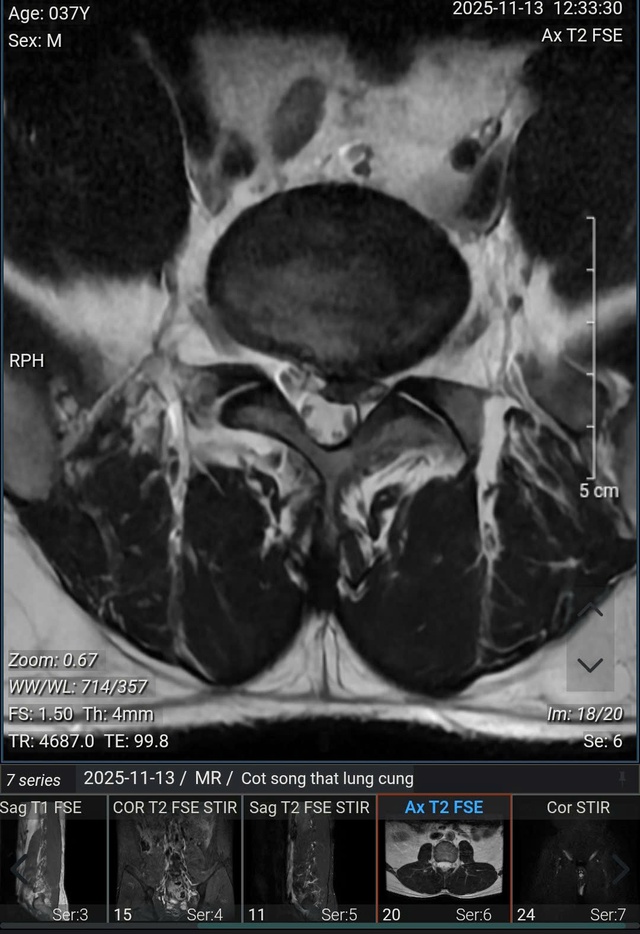 Người đàn ông 37 tuổi ở Hà Nội "nhận kết đắng" sau trận pickleball- Ảnh 1.