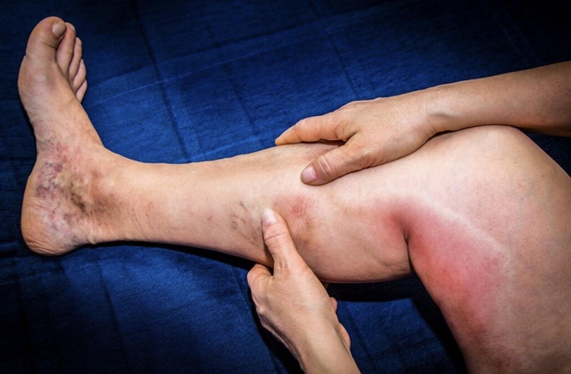 Không ho, không khó thở, người đàn ông 48 tuổi bị sưng chân đi bất ngờ khám phát hiện ung thư phổi giai đoạn 3: Bác sĩ cảnh báo nóng! - Ảnh 2.