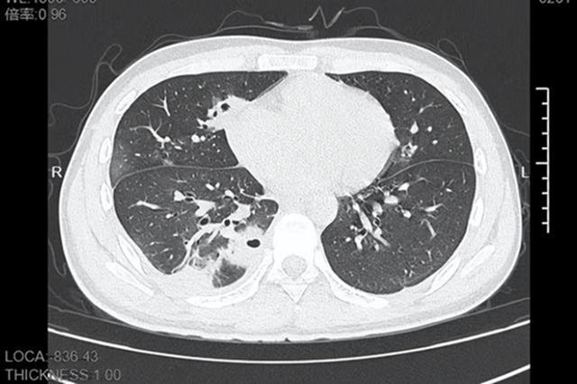 Chàng trai 20 tuổi bị thủng hơn 10 lỗ ở phổi sau khi nặn mụn!- Ảnh 2.