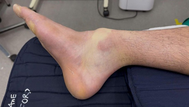 Đánh pickleball suốt 4 tiếng, nam thanh niên 28 tuổi gãy xương chân- Ảnh 1. Đánh pickleball suốt 4 tiếng, nam thanh niên 28 tuổi gãy xương chân- Ảnh 1.