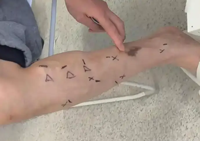 Đầu bếp 40 tuổi chân thâm đen gần như loét chỉ sau 1 năm vì thói quen nhiều người làm mỗi ngày- Ảnh 2.