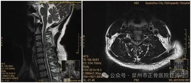 Người phụ nữ liệt nửa người v&igrave; trở m&igrave;nh lấy điện thoại giữa đ&ecirc;m: Đừng xem nhẹ những dấu hiệu cảnh b&aacute;o n&agrave;y- Ảnh 2.