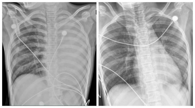 Bé trai 12 tuổi "phổi trắng xóa” chỉ sau 1 ngày mắc cúm: Cách phát hiện sớm cúm nặng ở trẻ- Ảnh 1. Bé trai 12 tuổi "phổi trắng xóa” chỉ sau 1 ngày mắc cúm: Cách phát hiện sớm cúm nặng ở trẻ- Ảnh 1.