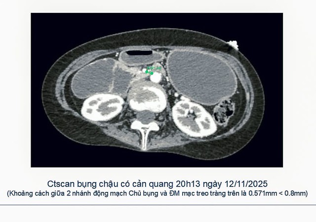 Bệnh viện Thống Nhất cứu sống nữ bệnh nh&acirc;n 19 tuổi mắc hội chứng hiếm g&acirc;y tắc ruột nguy kịch- Ảnh 2.