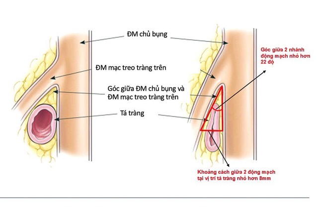 Bệnh viện Thống Nhất cứu sống nữ bệnh nh&acirc;n 19 tuổi mắc hội chứng hiếm g&acirc;y tắc ruột nguy kịch- Ảnh 3.