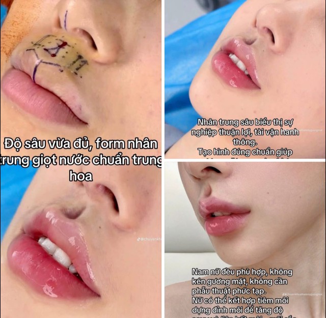 Nhân trung giọt nước chuẩn Trung Hoa khiến chị em phát sốt, người khen kẻ chê "chắc hứng nước luôn được"- Ảnh 1.