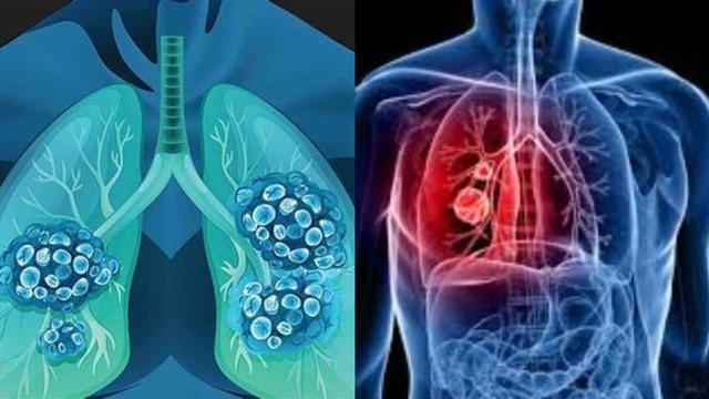 Cảnh báo không thể bỏ qua: Dấu hiệu sớm của UNG THƯ phổi không phải ho mà là 5 bất thường trên cơ thể - Ảnh 1. Cảnh báo không thể bỏ qua: Dấu hiệu sớm của UNG THƯ phổi không phải ho mà là 5 bất thường trên cơ thể - Ảnh 1.