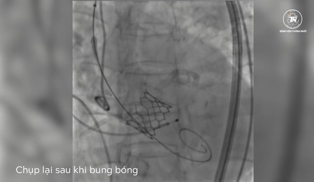 Hình ảnh chụp lúc bung van động mạch chủ. Hình ảnh chụp lúc bung van động mạch chủ.