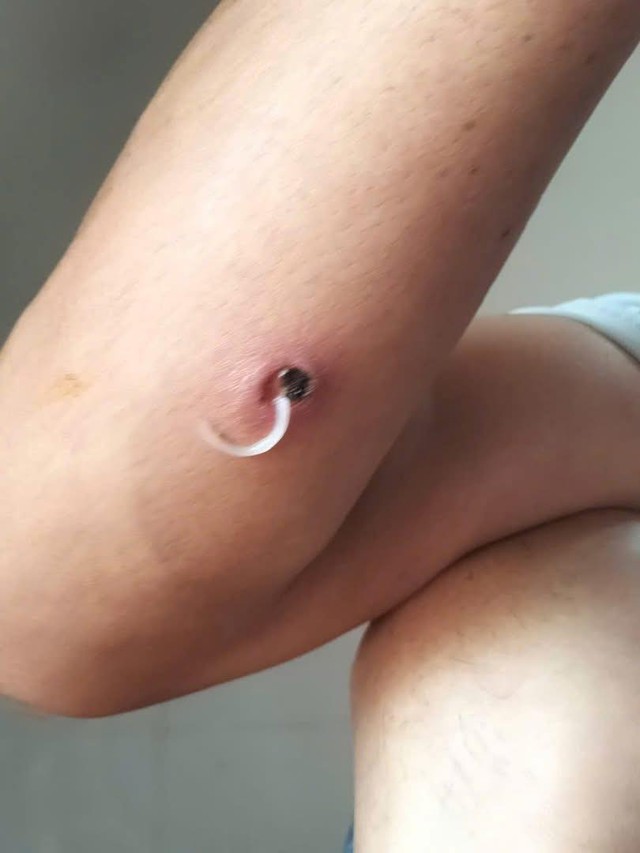Cảnh báo bệnh giun rồng xuất hiện tại một tỉnh ở Việt Nam- Ảnh 1. Cảnh báo bệnh hi88.com - hi88.win rồng xuất hiện tại một tỉnh ở Việt Nam- Ảnh 1.