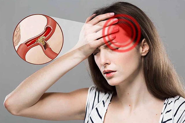 Ngày càng nhiều người bị nhồi máu não: Cảnh giác 3 loại gia vị là "thủ phạm", ghi nhớ quy tắc "một nhìn, hai nghe, ba cảm nhận" để phát hiện bệnh- Ảnh 4. Ngày càng nhiều người bị nhồi máu não: Cảnh giác 3 loại gia vị là "thủ phạm", ghi nhớ quy tắc "một nhìn, hai nghe, ba cảm nhận" để phát hiện bệnh- Ảnh 4.