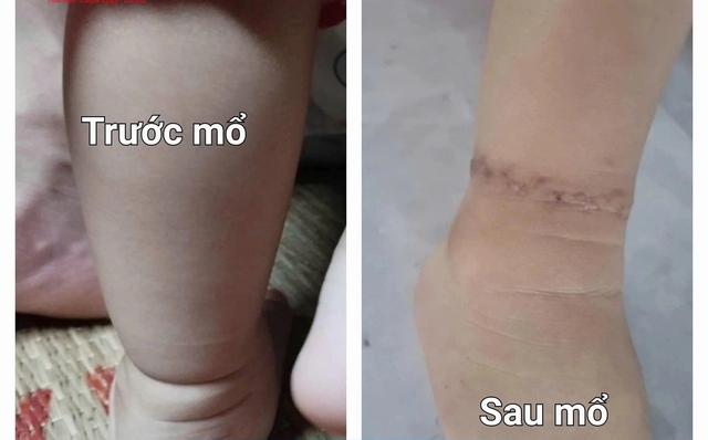 Thấy bàn tay bụ bẫm của con có 1 "chi tiết lạ", mẹ Việt lên mạng mới biết con có "dấu hiệu dị tật", cần đến khám bác sĩ Nhi gấp- Ảnh 3.