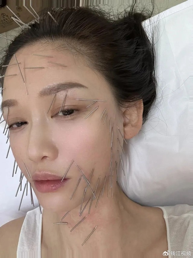 Trần Kiều Ân châm cả trăm cây kim lên mặt để làm đẹp ở tuổi 46 : "Bí thuật" trẻ hóa nhan sắc đang gây tranh cãi, "sơ hở là lệch mặt"- Ảnh 1. Trần Kiều Ân châm cả trăm cây kim lên mặt để làm đẹp ở tuổi 46 : "Bí thuật" trẻ hóa nhan sắc đang gây tranh cãi, "sơ hở là lệch mặt"- Ảnh 1.