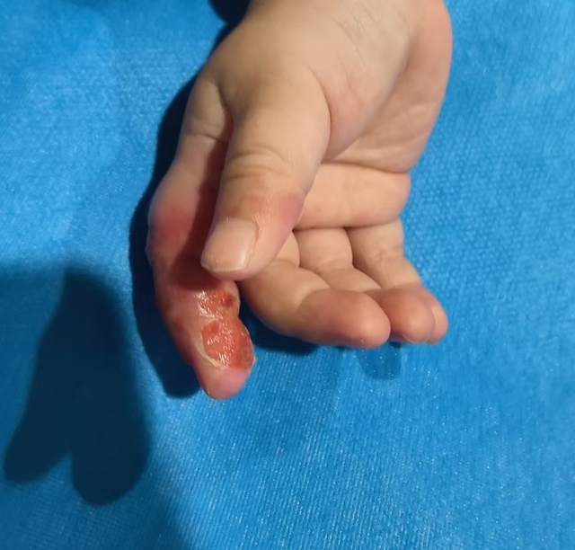 Bé gái 11 tháng suýt mất ngón tay vì phương pháp cai nghiện mút tay của người lớn- Ảnh 2. Bé gái 11 tháng suýt mất ngón tay vì phương pháp cai nghiện mút tay của người lớn- Ảnh 2.