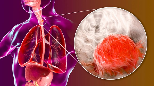 Ba thế hệ trong một gia đình cùng mắc ung thư, bác sĩ tiết lộ: Thói quen ăn "chết người" này chính là nguyên nhân- Ảnh 2. Ba thế hệ trong một gia đình cùng mắc hi88.con thư, bác sĩ tiết lộ: Thói quen ăn "chết người" này chính là nguyên nhân- Ảnh 2.