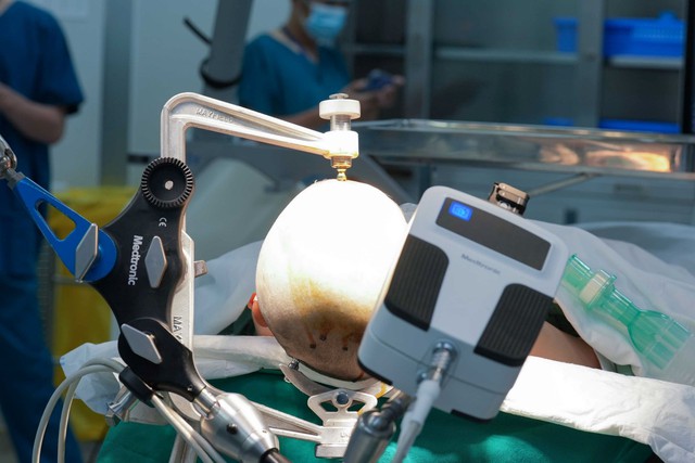 Cánh tay Robot AutoGuide giúp bác sĩ đặt điện cực vào nội sọ được chính xác và nhanh chóng.