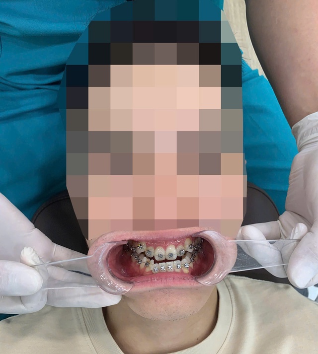 Trầm cảm vì niềng răng 3 năm vẫn "hô như ngày đầu"- Ảnh 2.