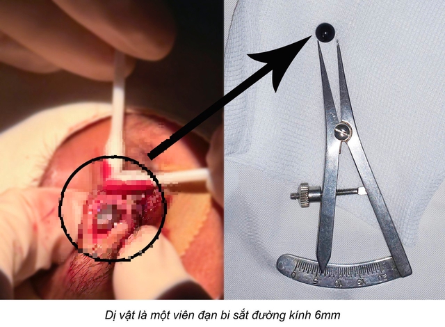 Hi hữu: Gắp viên bi sắt 6mm nằm trong mí mắt nam sinh 15 tuổi suốt nhiều ngày- Ảnh 1.