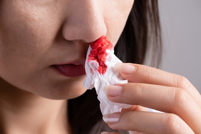 Bác sĩ cảnh báo: Cẩn trọng với những vết bầm lạ trên da!- Ảnh 1.