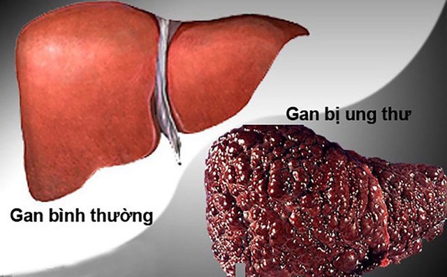 2 dấu hiệu ngứa ng&aacute;y cảnh b&aacute;o UNG THƯ GAN nhưng nhiều người NHẦM l&agrave; dị ứng - Ảnh 1.