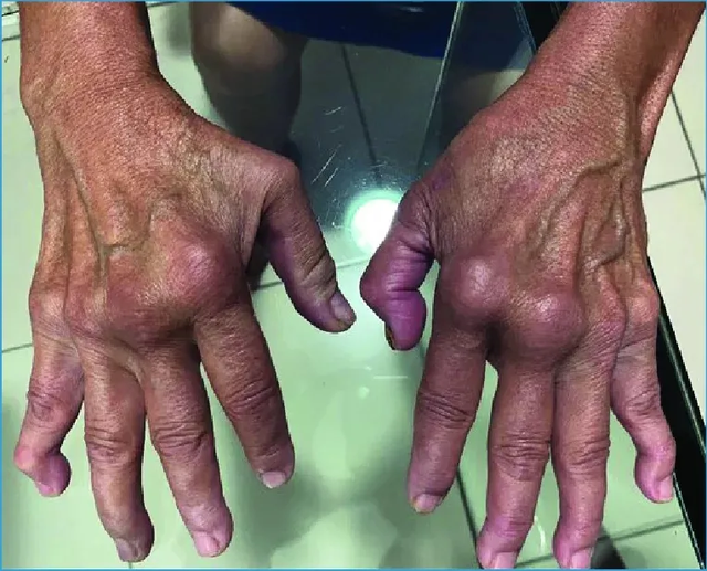 CDC Mỹ khuyến cáo cách phòng dịch Chikungunya đang bùng phát ở Trung Quốc, gần 3.000 ca mới trong một tuần- Ảnh 2. CDC Mỹ khuyến cáo cách phòng dịch Chikungunya đang bùng phát ở Trung Quốc, gần 3.000 ca mới trong một tuần- Ảnh 2.