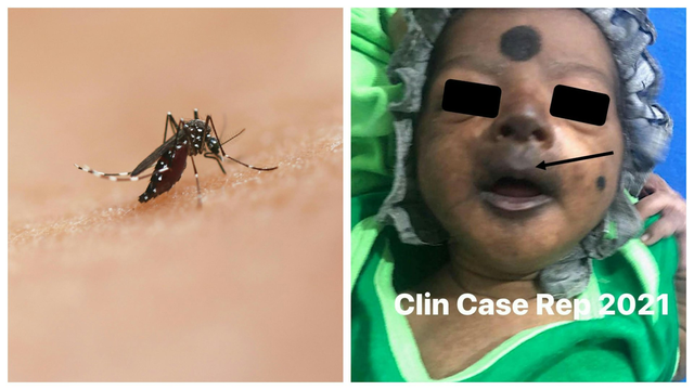 Bé trai 12 ngày tuổi mặt tím đen vì nhiễm virus Chikungunya có thể "phá hủy nội tạng"- Ảnh 1. Bé trai 12 ngày tuổi mặt tím đen vì nhiễm virus Chikungunya có thể "phá hủy nội tạng"- Ảnh 1.